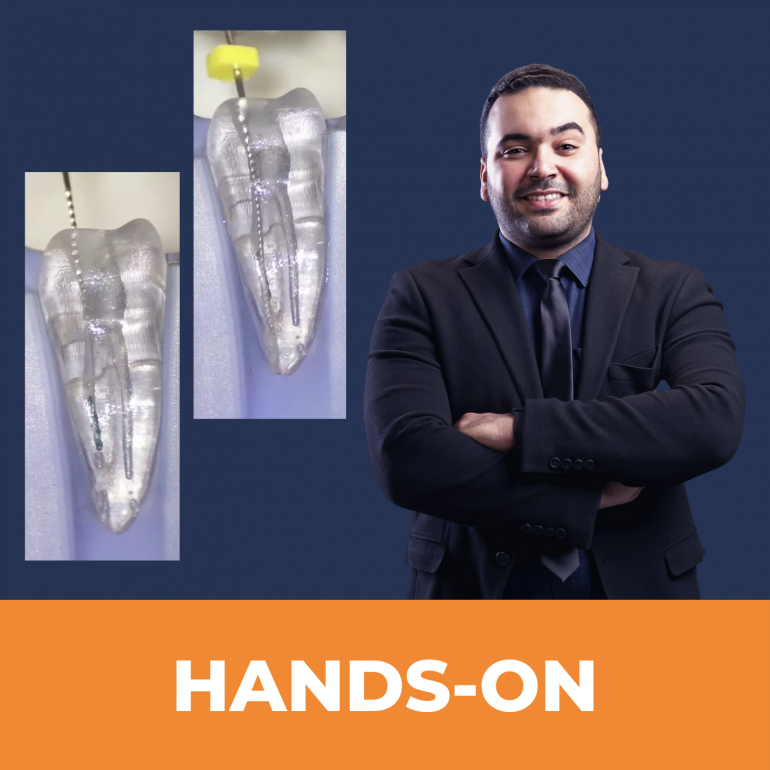 Betört endodonciai műszerek kivétele és lépcső bypass - Waleed Kurdi gyakorlati tanfolyama (Angol nyelvű)