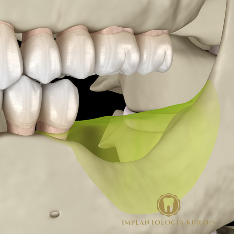 Az alapoktól a mester fokozatig! 10 napos orális implantológiai kurzus. 4. rész