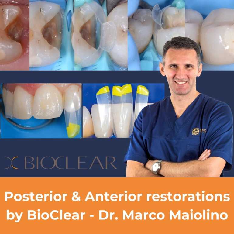 Posterior & Anterior restorations by BioClear - Dr. Marco Maiolino