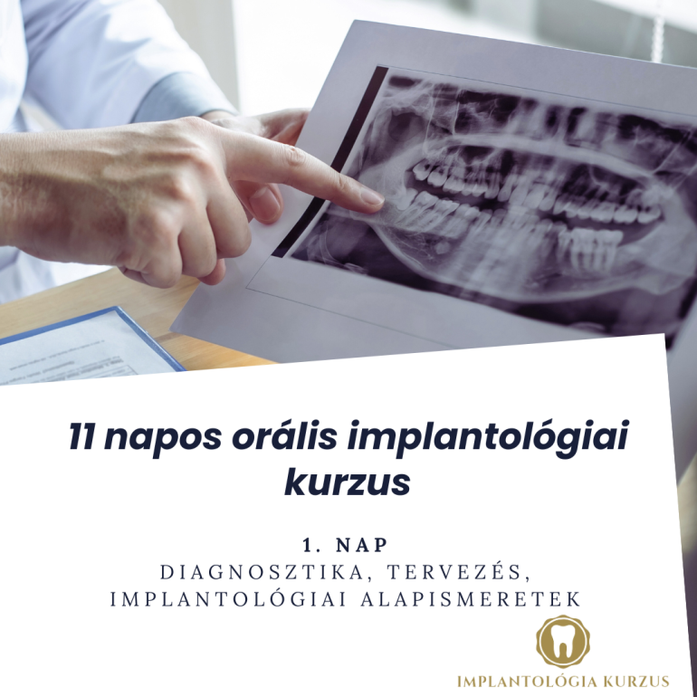 Az alapoktól a mester fokozatig! 11 napos orális implantológiai kurzus. 1. rész