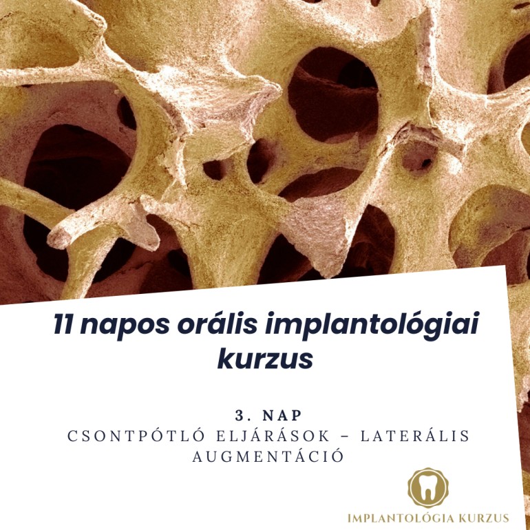 Az alapoktól a mester fokozatig! 11 napos orális implantológiai kurzus. 3. rész
