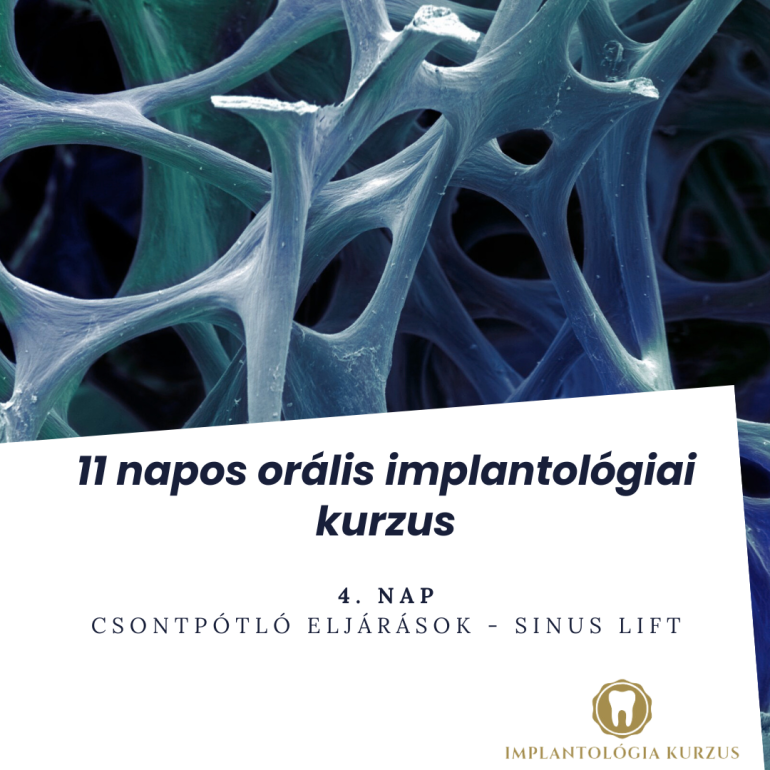 Az alapoktól a mester fokozatig! 11 napos orális implantológiai kurzus. 4. rész