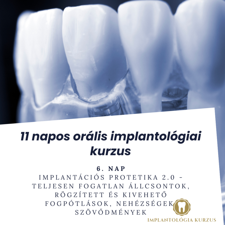 Az alapoktól a mester fokozatig! 11 napos orális implantológiai kurzus. 6. rész