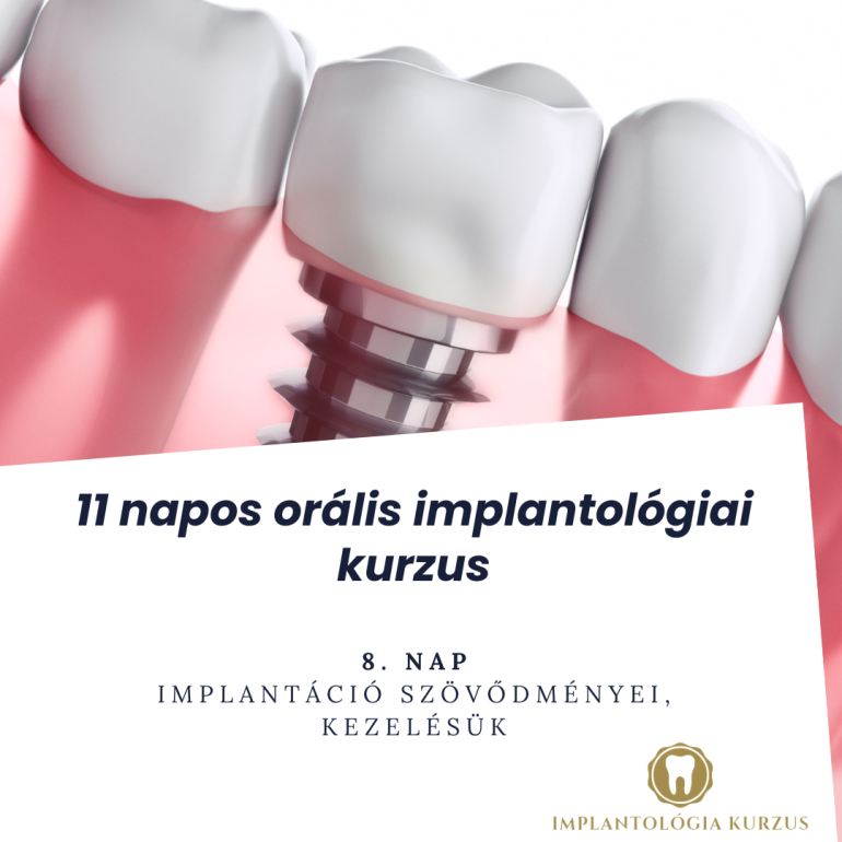 Az alapoktól a mester fokozatig! 11 napos orális implantológiai kurzus. 8. rész