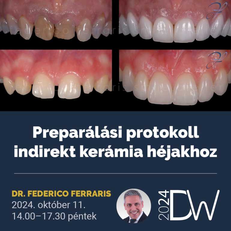 Preparálási protokoll indirekt kerámia héjakhoz