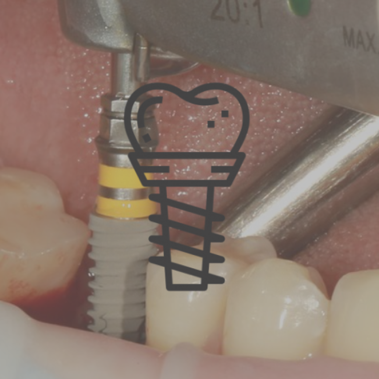 11 napos Implantológiai alapkurzus 2. nap  - Implantátum behelyezésének elmélete és gyakorlata. Az implantátum körüli lágyszövetek formázása.