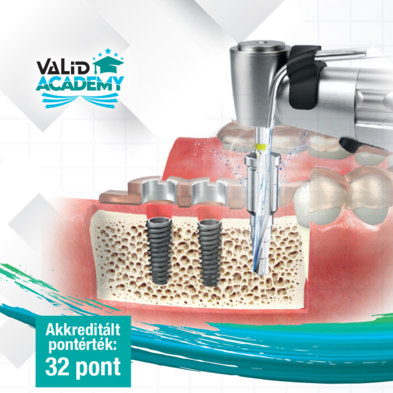 Digitálisan navigált implantológia